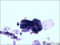 TCT   血性背景。图10