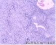 膀胱肿物 新加免疫组化图13