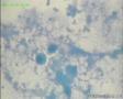 50岁体检病人（背景是否为肿瘤素质？）图12