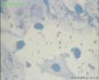 50岁体检病人（背景是否为肿瘤素质？）图1