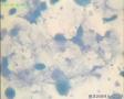 50岁体检病人（背景是否为肿瘤素质？）图4