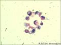 胸水找见腺癌细胞图8