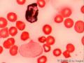 这是淋巴瘤细胞吗？这个结果我们应该怎么报告？图20