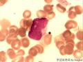 这是淋巴瘤细胞吗？这个结果我们应该怎么报告？图7
