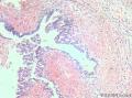 卵巢交界性乳头状浆液性囊腺瘤？有癌变？图22