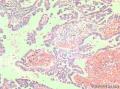 卵巢交界性乳头状浆液性囊腺瘤？有癌变？图26