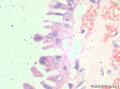 卵巢交界性乳头状浆液性囊腺瘤？有癌变？图5