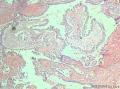 卵巢交界性乳头状浆液性囊腺瘤？有癌变？图15