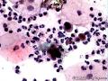 这是外院的病例，医生发的是ASCUS，我初学，认为有挖空细胞和可发HSIL。有组织学对照，请大家发表高见，给我启示，谢谢！图25