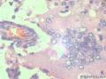 卵巢交界性乳头状浆液性囊腺瘤？有癌变？图3