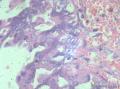 卵巢交界性乳头状浆液性囊腺瘤？有癌变？图23