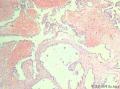 卵巢交界性乳头状浆液性囊腺瘤？有癌变？图7