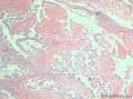 卵巢交界性乳头状浆液性囊腺瘤？有癌变？图1