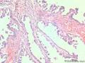 卵巢交界性乳头状浆液性囊腺瘤？有癌变？图8