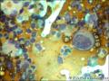 胸水找见腺癌细胞2图19