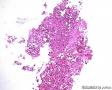 纤支镜肺活检1：腺癌或鳞癌？含IHC图2