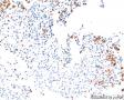 纤支镜肺活检1：腺癌或鳞癌？含IHC图12