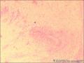 咽喉部新生物图5