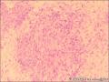 咽喉部新生物图15