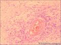 咽喉部新生物图16