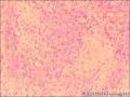 咽喉部新生物图19