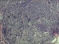 颈部肿物图5