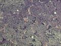 颈部肿物图2