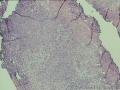 是癌吗？什么类型？图1