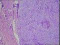 甲状腺肿瘤，请大家看看是原发还是转移？原发的是什么类型？图5