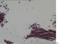 新生儿 女 牙龈黄豆大小肿物，质硬。临床：出生后两天变小，后面变小约4mm,蒂变细如线状。大家看看是什么？图8
