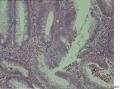结肠肿物，绕肠管半周，活检，大家看看够癌不？图12