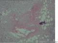 男19岁，腰部皮下无痛结节2X0.5厘米数周，大家看看像结核不？图2