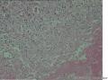 男19岁，腰部皮下无痛结节2X0.5厘米数周，大家看看像结核不？图6