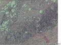 男19岁，腰部皮下无痛结节2X0.5厘米数周，大家看看像结核不？图4