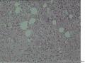 男19岁，腰部皮下无痛结节2X0.5厘米数周，大家看看像结核不？图7