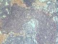 宫内膜，50岁，红圈里面的这块组织是什么？有问题吗？？图12