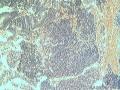 宫内膜，50岁，红圈里面的这块组织是什么？有问题吗？？图9
