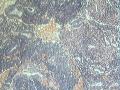 宫内膜，50岁，红圈里面的这块组织是什么？有问题吗？？图11