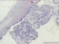 交界性恶变？一级乳头状癌？图24