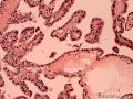 16岁甲状腺肿块图10