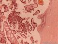 16岁甲状腺肿块图2