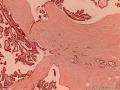 16岁甲状腺肿块图4