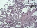46y,tct(看看活检)图10