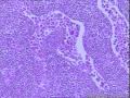 男60岁,左腋窝包块,求助转移癌来源?图5