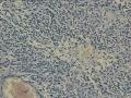 星形细胞瘤，够III级不？图45