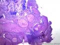 老师帮忙看看球结膜新生物（球结膜皮样瘤？鳞状上皮瘤样增生？毛源性？）图2