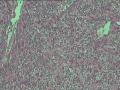 头皮肿物图18