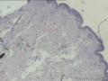 纤维瘤病？还是炎症？图1