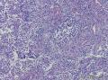 尿路上皮癌，低级别or高级别？是否浸润？图10