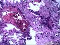 甲状腺肿物图12